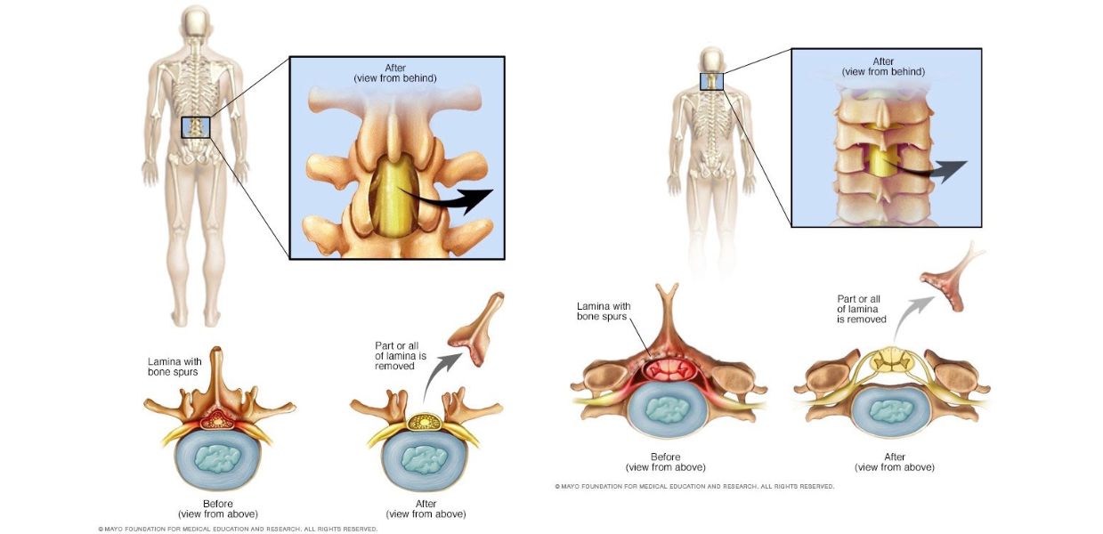 Spine Surgery in India